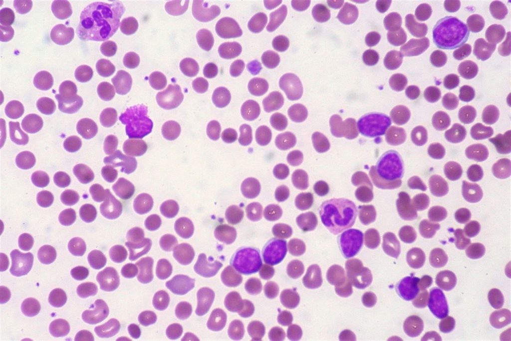 Leucemia linfatica cronica e mieloma multiplo, corso ECM a Messina