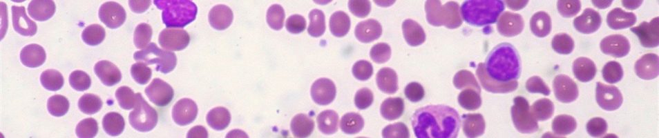 Leucemia linfatica cronica e mieloma multiplo, corso ECM a Messina