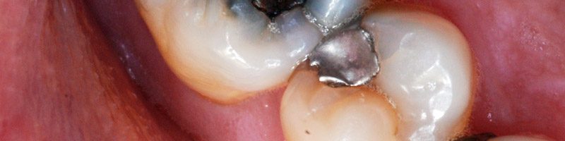 Nuove disposizioni ministeriali per l’amalgama dentale