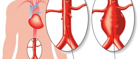 Uso di medicinali contenenti fluorochinoloni: varie comunicazioni e rischio di aneurisma e dissezione dell’aorta