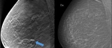 Diagnostica Senologica del Papardo: arrivano due mammografi e un ecografo di ultima generazione