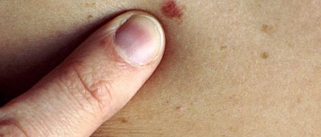 Farmaci con idroclorotiazide (HTCZ): rischio tumore cutaneo non melanoma (TCNM)