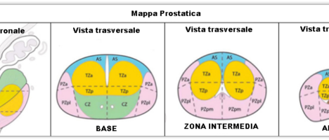 La biopsia prostatica fusion cognitiva: quando l’invisibile si rende visibile nel cervello dell’operatore