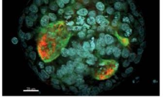 Cellule staminali tumorali: un filo rosso tra ricerca, clinica e sanità