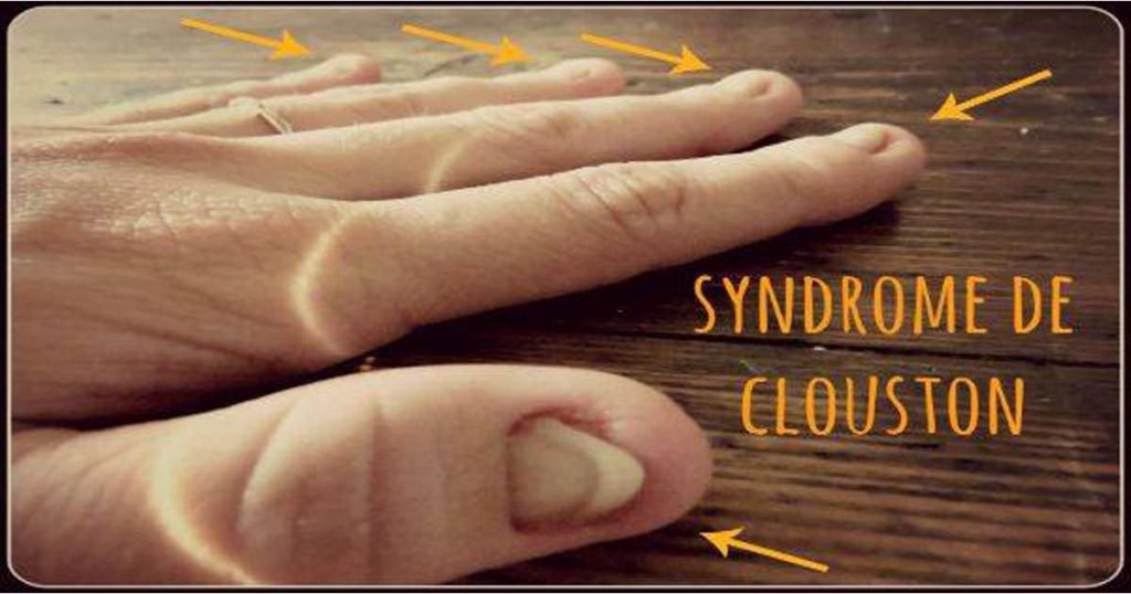 Individuato anticorpo monoclonale per contrastare la sindrome di Clouston