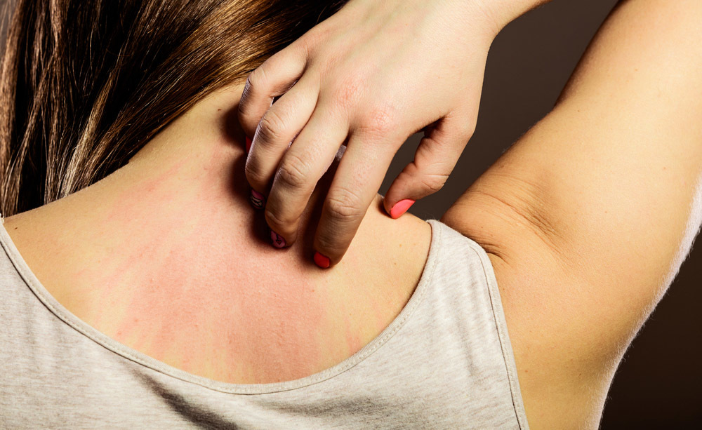 Le allergie non fanno ingrassare, le intolleranze provocano ritenzione