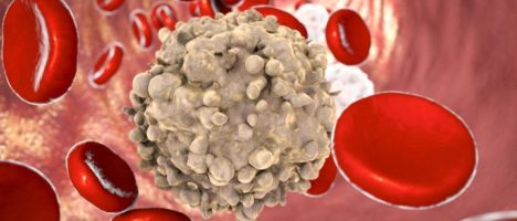 Amadori (AIL): con tumore sangue rischio letalità più alto 40%. “Reparti oncoematologia anche in prima ondata hanno garantito cure”