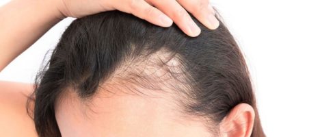 La perdita di capelli nel 30% dei pazienti post-Covid