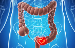 Al via “La cura non ha età”: la campagna rivolta agli anziani con tumore al colon retto metastatico per aiutarli ad affrontare la malattia