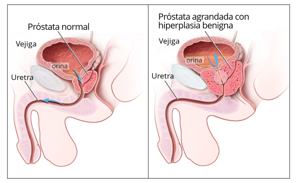 Cancro della prostata: enzalutamide è stata approvata dalla Commissione Europea per il trattamento degli uomini con la patologia metastatica sensibile agli ormoni