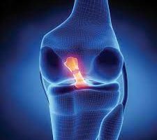 Legamento crociato anteriore ‘fondamentale per le attività’. Adriani (Gemelli): intervento in artroscopia rispetta anatomia e ripristina funzionalità