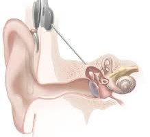 Recuperare l’udito, come funzionano gli impianti cocleari. Cuda (SIOeChCF):”bambini utente principale, dopo impianto indistinguibili da chi sente normalmente”