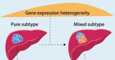 Un nuovo studio sul cancro primario del fegato: nuove strategie mirate a un panorama dinamico di tumori eterogenei