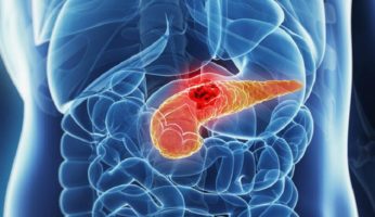 Tumore del pancreas metastatico: la nanotecnologia alla basedel primo e unico farmaco approvato per i pazienti in seconda linea di trattamento