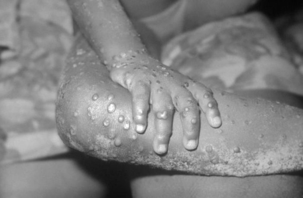 Monkeypox non è un’emergenza globale per ora, afferma l’OMS. 3 cose che dobbiamo sapere in seguito su come sta mutando e si sta diffondendo