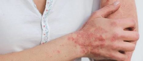 Dermatite atopica, disponibile in Italia Abrocitinib per pazienti over 18