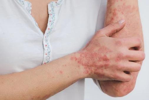 Dermatite atopica, disponibile in Italia Abrocitinib per pazienti over 18