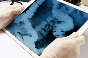 Il tumore al colon sta aumentando tra i giovani?