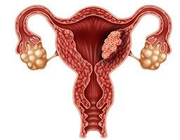 ISS: Tumore dell’utero