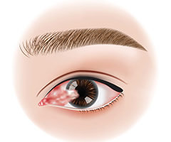 ISS: Pterigio Lo pterigio è una malattia degenerativa benigna (non tumorale) della superficie anteriore di uno o di entrambi gli occhi, a volte anche contemporaneamente