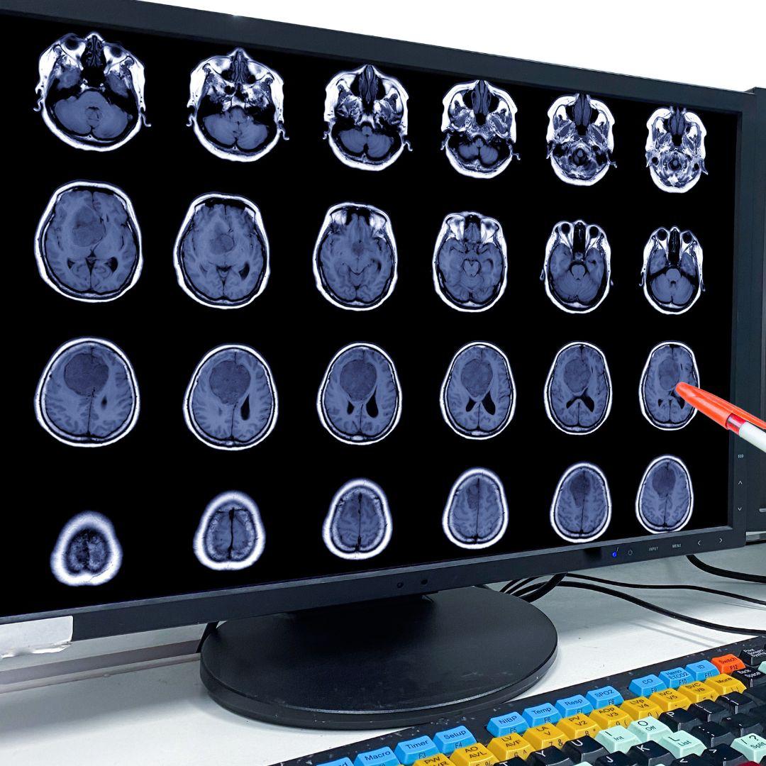 Tumori cerebrali: la neurochirurgia del policlinico di Messina prima in Sicilia come numero di interventi