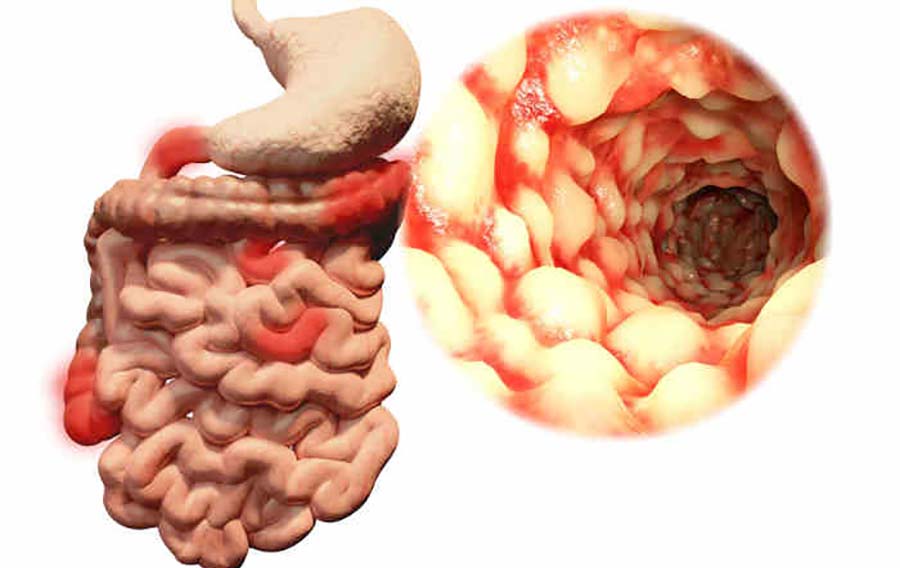 Malattia di Crohn: altissima prevalenza in Sicilia. Si stimano 12.000-14.000 pazienti, in costante aumento in tutte le fasce d’età