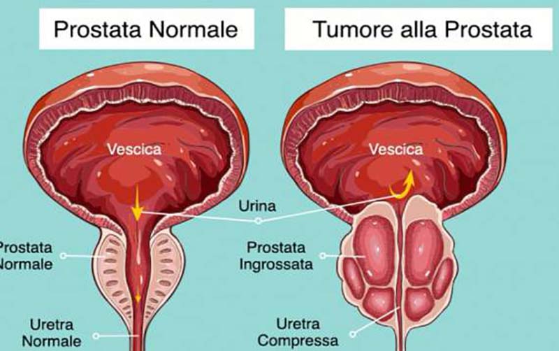 Disponibile in Sicilia la prima terapia con radioligandi per il carcinoma prostatico metastatico resistente alla castrazione (mCRPC) positivo al PSMA