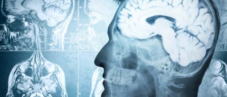 L’importanza della diagnosi precoce nelle demenze reversibili, pubblicato sulla rivista “Medicina” uno studio condotto anche da docenti UniMe