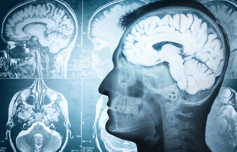 L’importanza della diagnosi precoce nelle demenze reversibili, pubblicato sulla rivista “Medicina” uno studio condotto anche da docenti UniMe