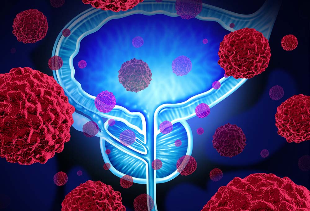 Dalla prevenzione alle cure disponibili. Il cancro alla prostata è una delle neoplasie più comuni al mondo tra gli uomini