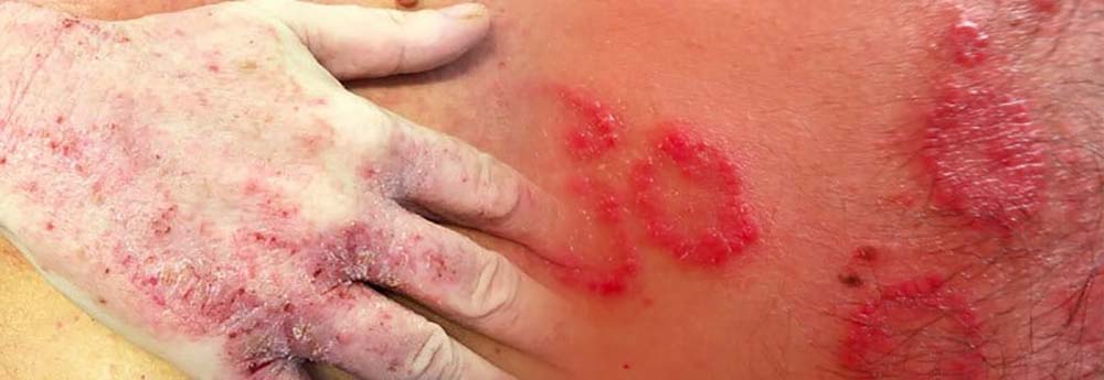 Dermatite atopica: i pazienti chiedono riconoscimenti e tutele