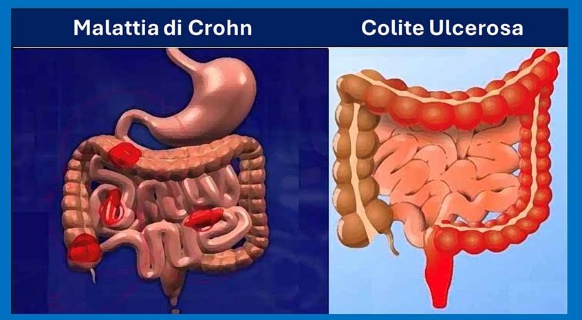 Malattie infiammatorie croniche intestinali: al XVI Congresso Nazionale IG-IBD nasce il comitato scientifico per il primo sistema di raccolta dati nazionale