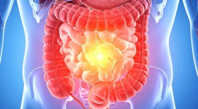 Malattie infiammatorie croniche intestinali: Il 31 Gennaio al Policlinico di Messina un focus su bambini e adulti