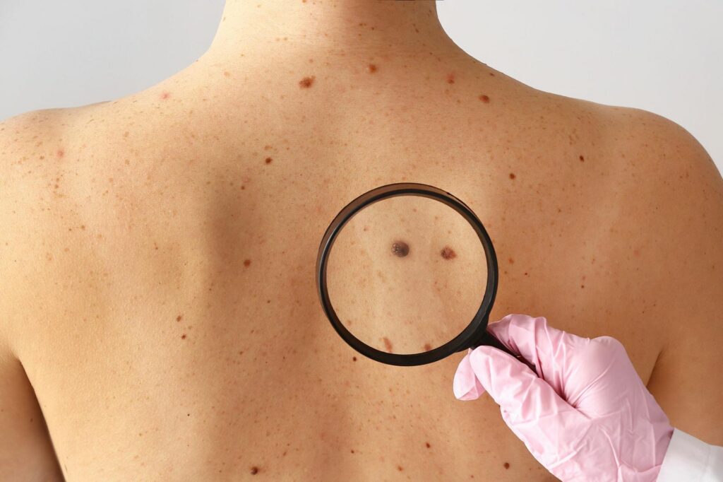 AOU G. Martino di Messina Melanoma “Save Your Skin”: Sabato 23 Maggio visite gratuite in dermatologia