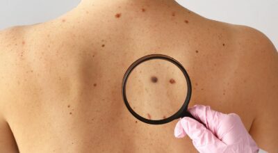 AOU G. Martino di Messina Melanoma “Save Your Skin”: Sabato 23 Maggio visite gratuite in dermatologia